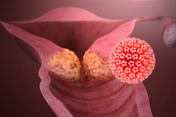 ویروس پاپیلومای انسانی، زگیل تناسلی یا HPV